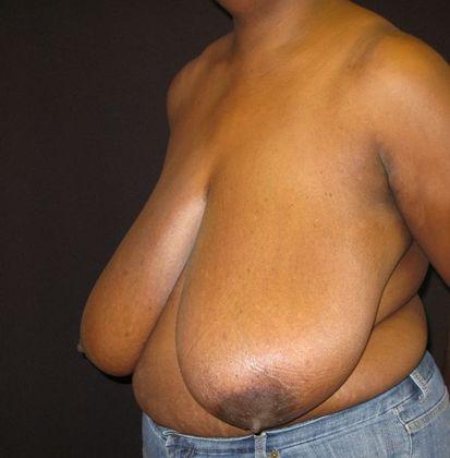 Breast Reduction: Case 3 - before