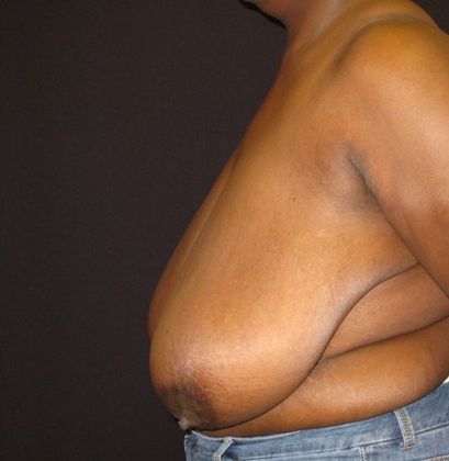 Breast Reduction: Case 3 - before