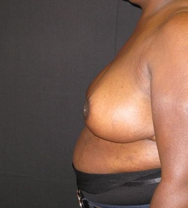 Breast Reduction: Case 3 - after 3 months