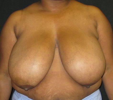 Breast Reduction: Case 4 - before