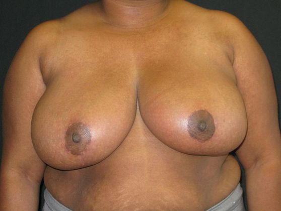 Breast Reduction: Case 4 - after 5 months