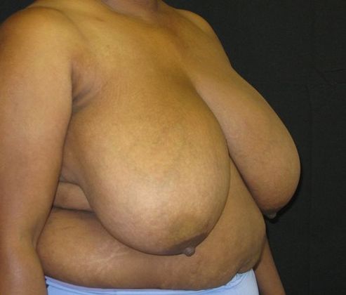 Breast Reduction: Case 4 - before