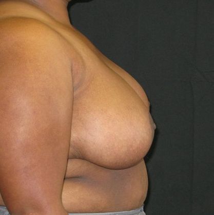 Breast Reduction: Case 4 - after 5 months