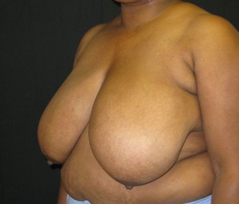 Breast Reduction: Case 4 - before