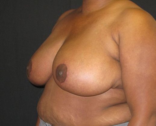 Breast Reduction: Case 4 - after 5 months