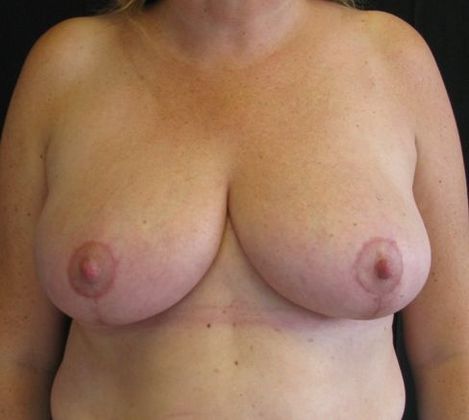 Breast Reduction: Case 5 - after 1 months