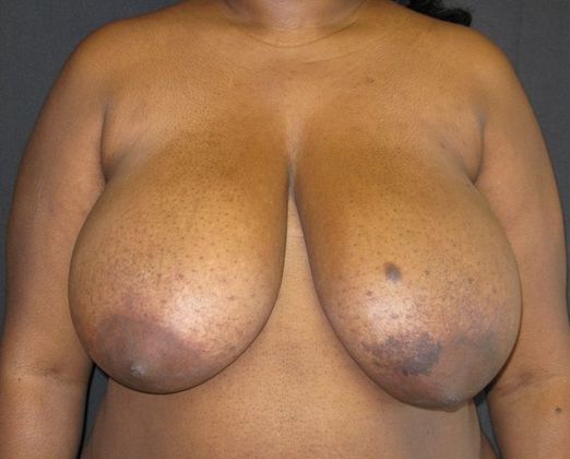 Breast Reduction Case 6 - Before