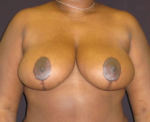 Breast Reduction Case 6 - After