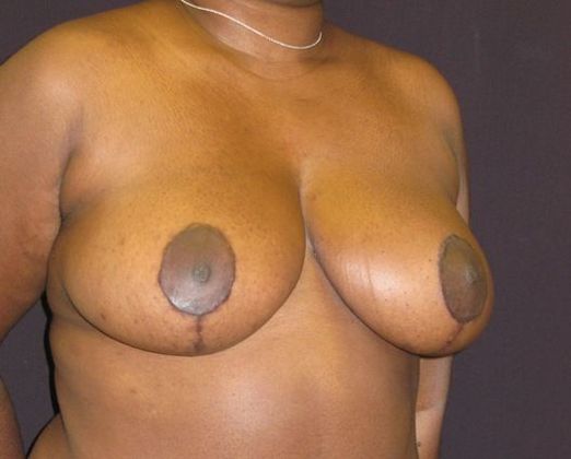 Breast Reduction: Case 6 - after 9 months