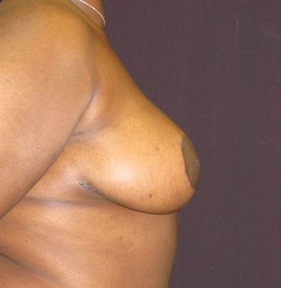 Breast Reduction: Case 6 - after 9 months