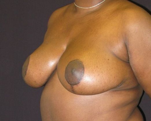 Breast Reduction: Case 6 - after 9 months