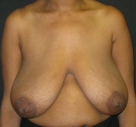 Breast Reduction: Case 7 - before