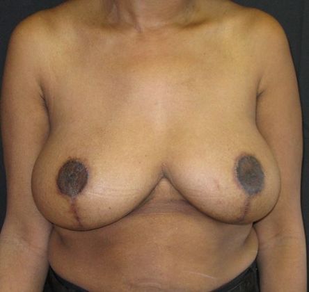 Breast Reduction: Case 7 - after 1 year