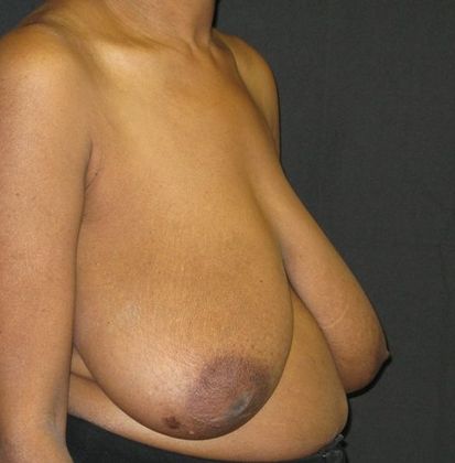Breast Reduction: Case 7 - before