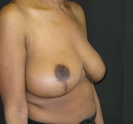 Breast Reduction: Case 7 - after 1 year