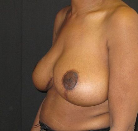 Breast Reduction: Case 7 - after