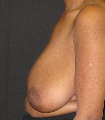 Breast Reduction: Case 7 - before