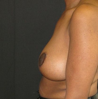 Breast Reduction: Case 7 - after 1 year