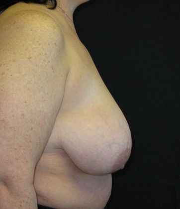 Breast Reduction: Case 8 - before