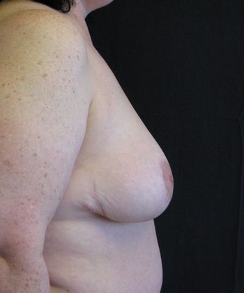 Breast Reduction: Case 8 - after 1 year