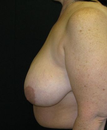 Breast Reduction: Case 8 - before