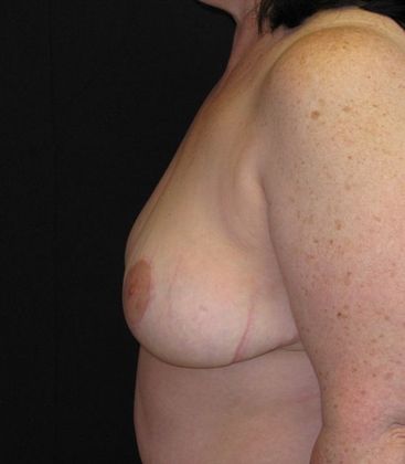 Breast Reduction: Case 8 - after 1 year