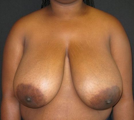 Breast Reduction: Case 9 - before
