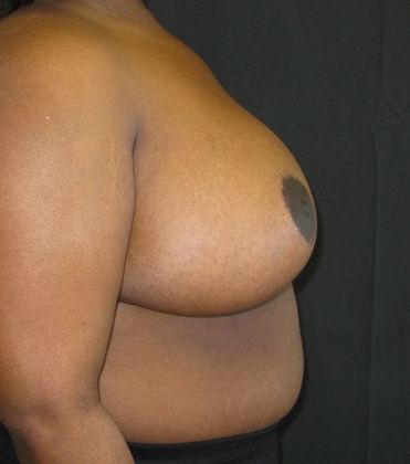 Breast Reduction: Case 9 - after 6 months