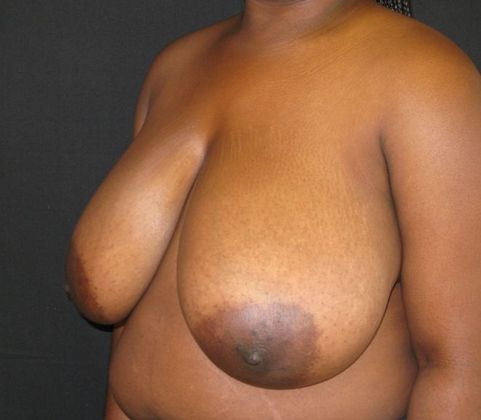 Breast Reduction: Case 9 - before