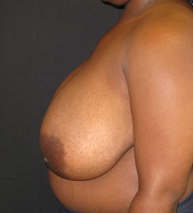 Breast Reduction: Case 9 - before