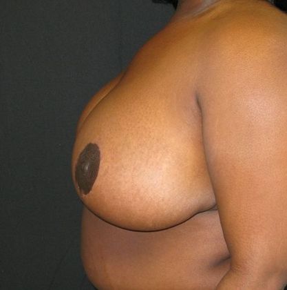 Breast Reduction: Case 9 - after 6 months