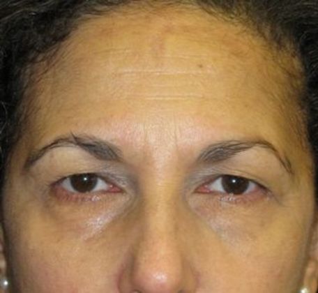 Brow lift Case 1 - Before