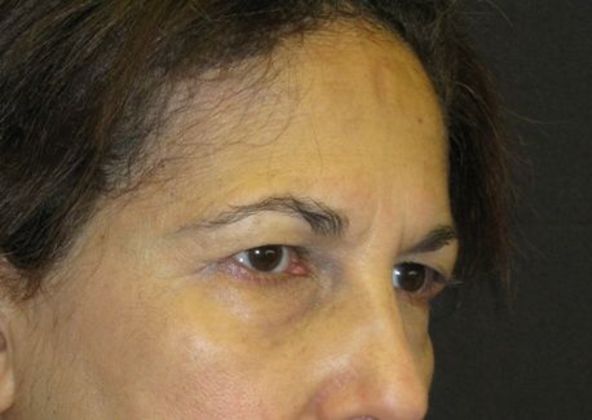 Brow lift: Case 1 - before