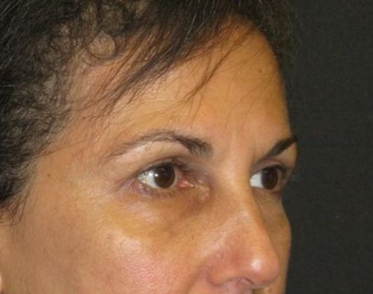 Brow lift: Case 1 - after 4 months