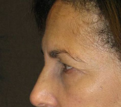 Brow lift: Case 1 - before