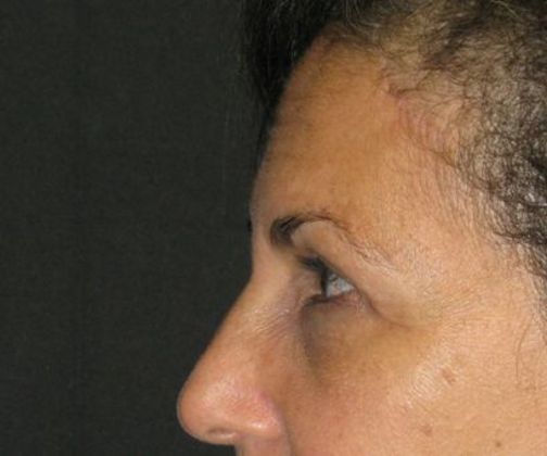 Brow lift: Case 1 - after 4 months