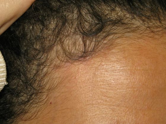 Brow lift: Case 1 - right hairline scar after 4 months