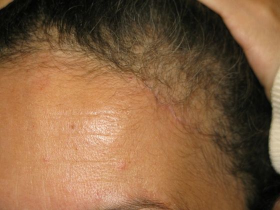 Brow lift: Case 1 - left hairline scar after 4 months