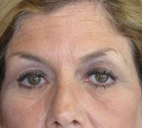 Brow lift Case 2 - Before