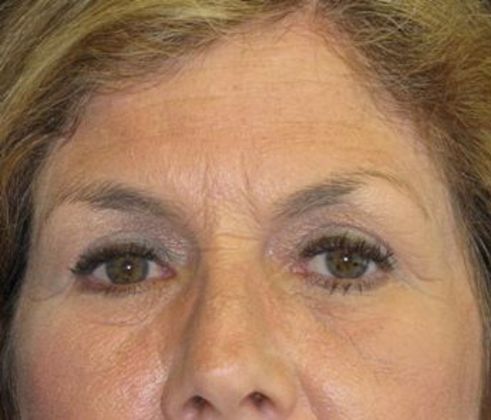 Brow lift Case 2 - After