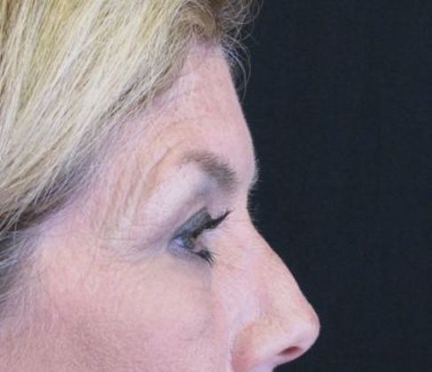 Brow lift: Case 2 - before