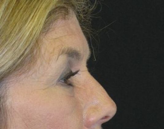 Brow lift: Case 2 - after 9 months