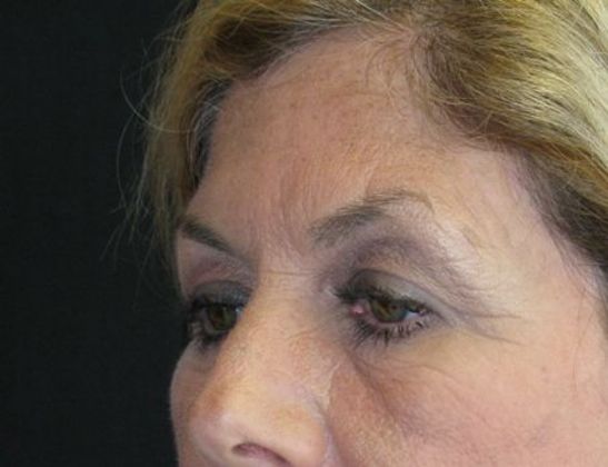 Brow lift: Case 2 - before