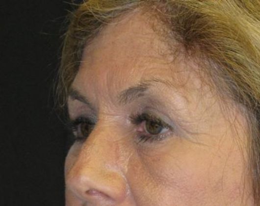 Brow lift: Case 2 - after 9 months