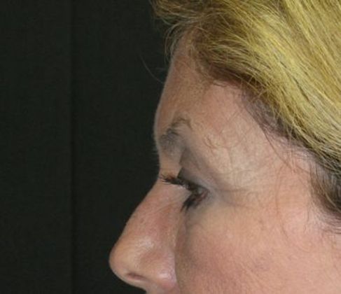 Brow lift: Case 2 - before