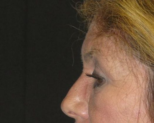 Brow lift: Case 2 - after 9 months