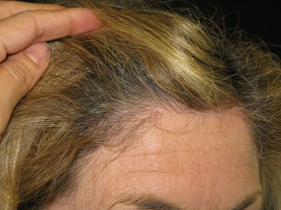 Brow lift: Case 2 - right hairline scar after 9 months