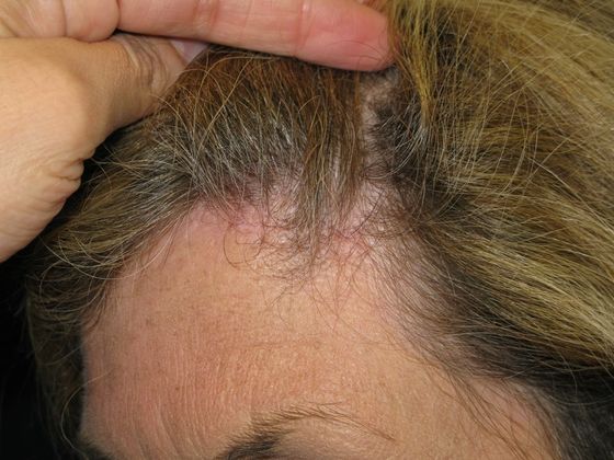 Brow lift: Case 2 - left hairline scar after 9 months