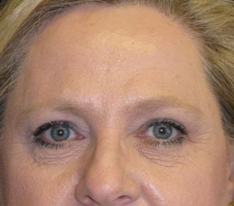 Brow lift Case 3 - After