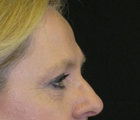 Brow lift: Case 3 - after 8 months